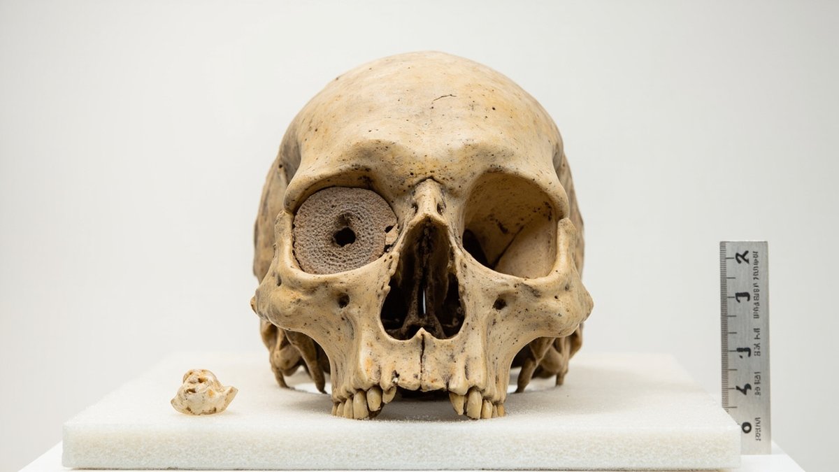 famous archaeological finds 2026 - 5000 year old skull with ancient brain surgery evidence in Turkey